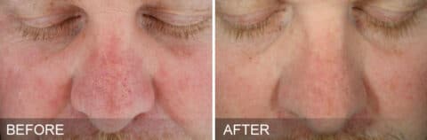 hydrafacial