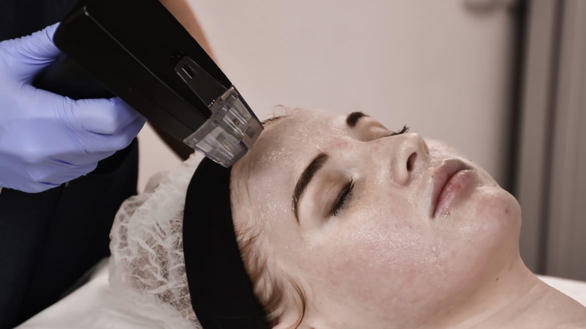 Morpheus8 RF Microneedling being performed in Boca Raton, FL